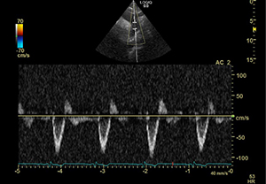 Ultrasound image of the aortic arch 