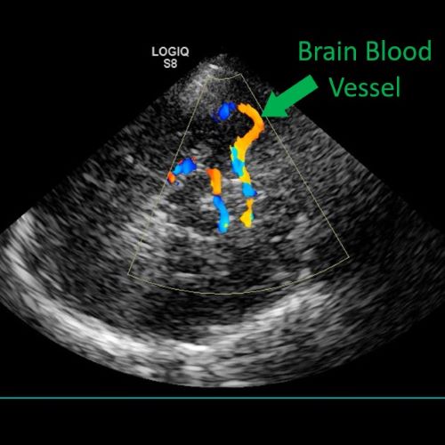 An example of a brain blood vessel image collected with ultrasound. An example of a brain blood vessel image collected with ultrasound.