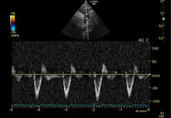 An example image of one of the large blood vessels around the heart taken with ultrasound.