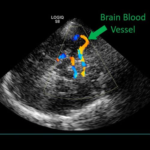 An example of a brain blood vessel image collected with ultrasound.