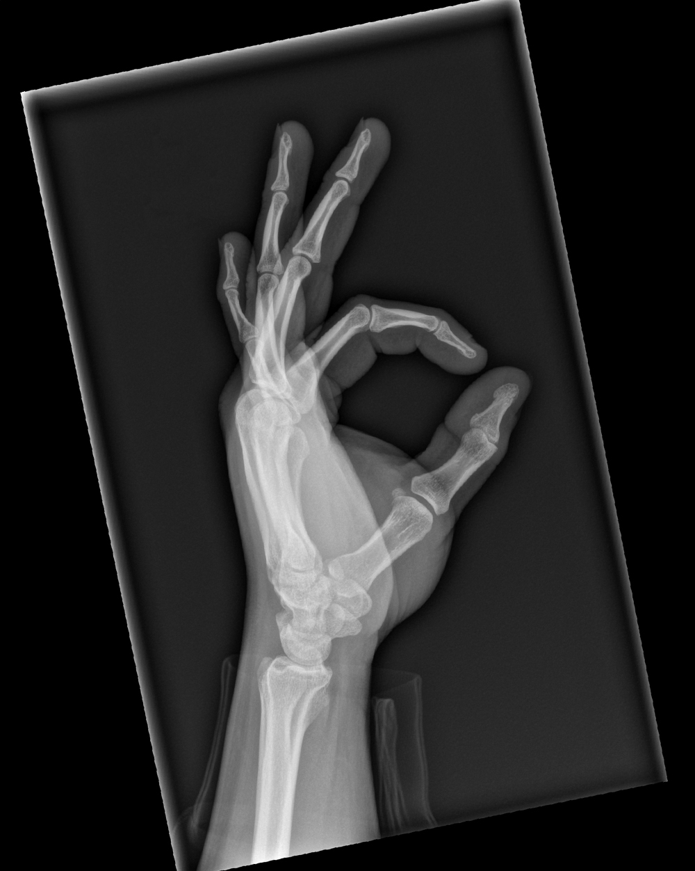 An X-Ray of a hand doing the Wildcat symbol.