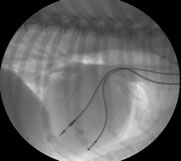 photo of inserting pacemaker