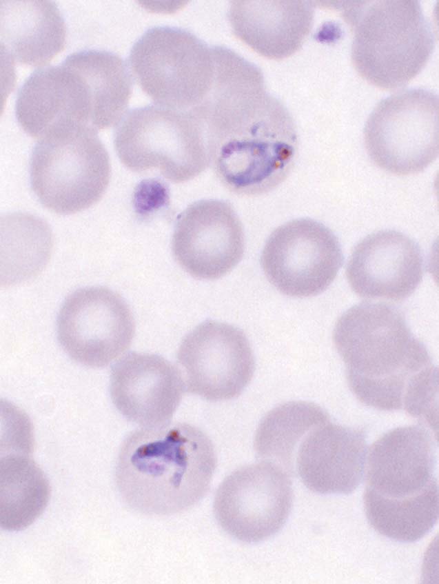 Malaria Workup: Approach Considerations, Blood Smears, Alternatives to  Blood Smear Testing